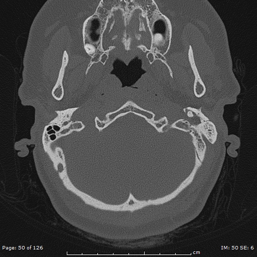 Cholesteatoma - external auditory canal (Radiopaedia 88452-105096 Axial bone window 13).jpg