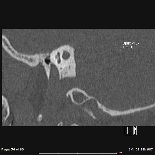 File:Cholesteatoma - external auditory canal (Radiopaedia 88452-105096 Sagittal bone window 56).jpg