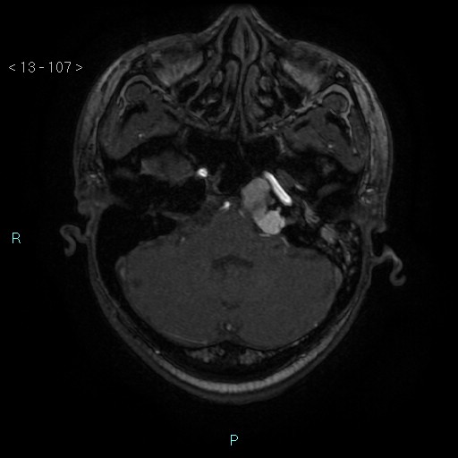 Cholesterol granuloma of the petrous apex (Radiopaedia 64358-73140 Axial TOF 3D 52).jpg