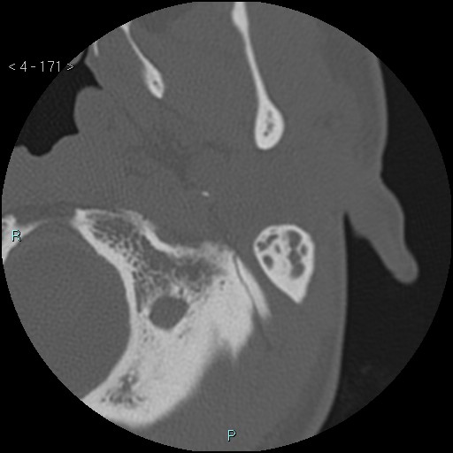 File:Cholesterol granuloma of the petrous apex (Radiopaedia 64358-73141 Axial bone window 82).jpg