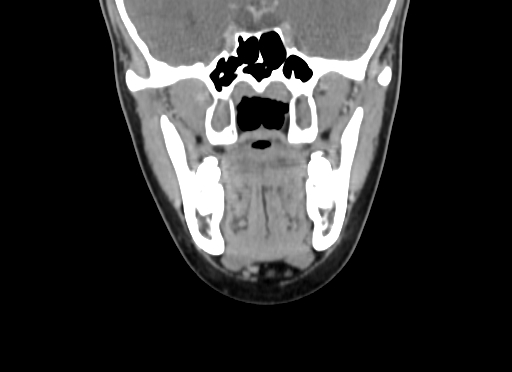 Chondroblastic osteosarcoma (Radiopaedia 67363-76741 D 51).jpg