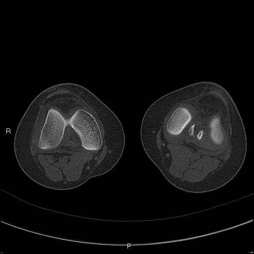 Chondroblastoma (Radiopaedia 62721-71030 Axial bone window 30).jpg