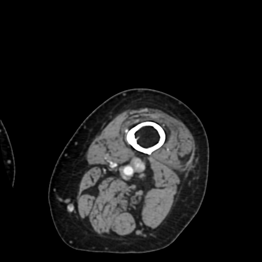 Chondrosarcoma - femur (Radiopaedia 64187-72954 Axial with contrast 3).jpg