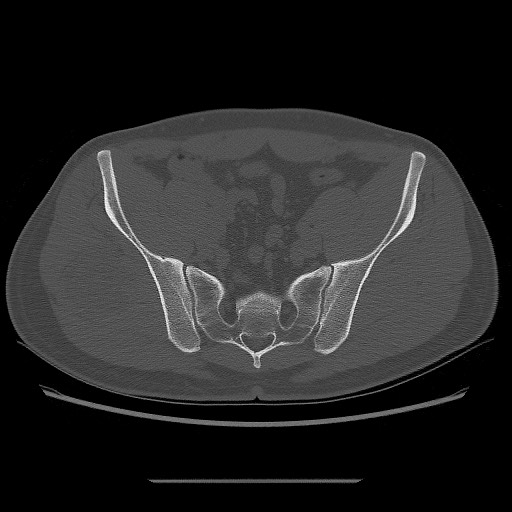 File:Chondrosarcoma of iliac wing (Radiopaedia 63861-72599 Axial bone window 64).jpg
