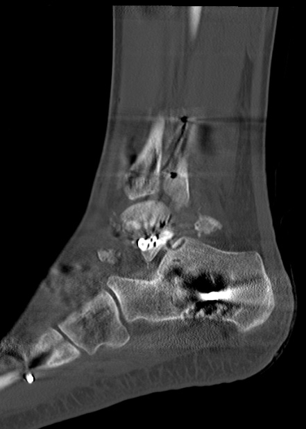 Chopart fracture (Radiopaedia 35347-36861 Sagittal bone window 51).jpg