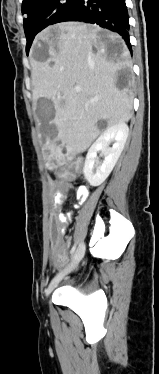 Choriocarcinoma liver metastases (Radiopaedia 74768-85766 C 124).jpg