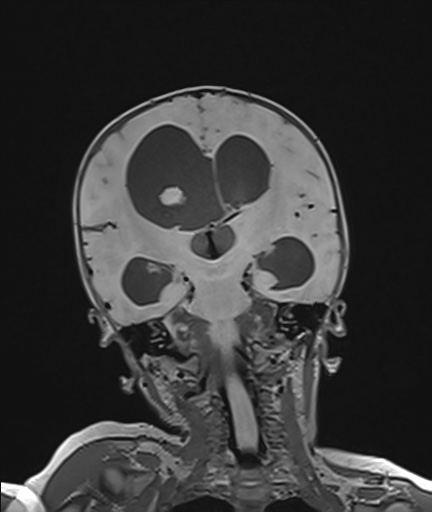 Choroid plexus papilloma (Radiopaedia 84612-100019 Coronal FLAIR 72).jpg