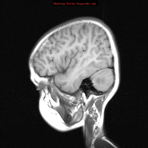 File:Choroid plexus papilloma (Radiopaedia 8466-9290 Sagittal T1 17).jpg