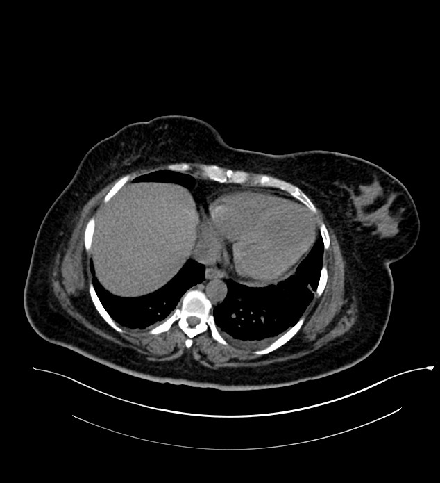 Chromophobe renal cell carcinoma (Radiopaedia 84239-99519 Axial non-contrast 23).jpg