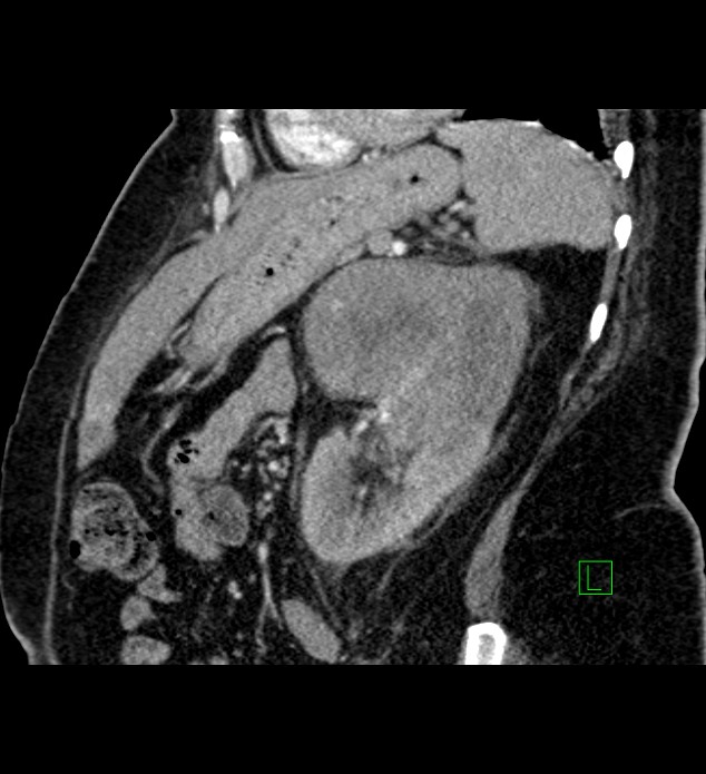 Chromophobe renal cell carcinoma (Radiopaedia 84239-99519 D 39).jpg