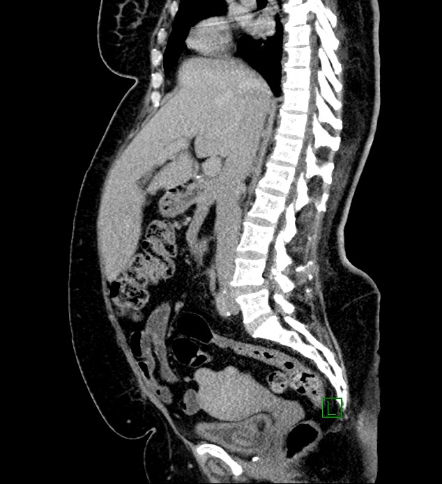 Chromophobe renal cell carcinoma (Radiopaedia 84239-99519 G 68).jpg