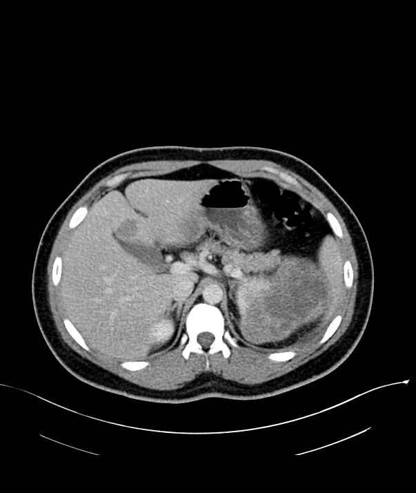 Chromophobe renal cell carcinoma (Radiopaedia 84255-99542 F 23).jpg