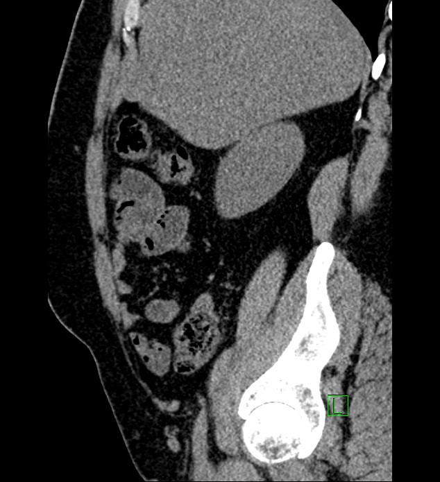Chromophobe renal cell carcinoma (Radiopaedia 84286-99573 C 139).jpg