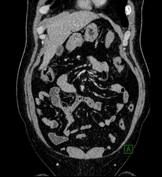 Chromophobe renal cell carcinoma (Radiopaedia 84286-99573 H 48).jpg