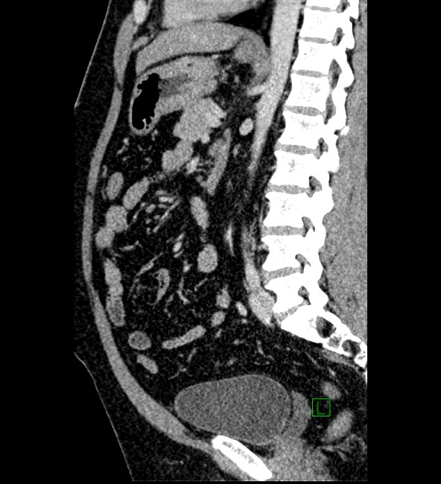 Chromophobe renal cell carcinoma (Radiopaedia 84286-99573 I 80).jpg