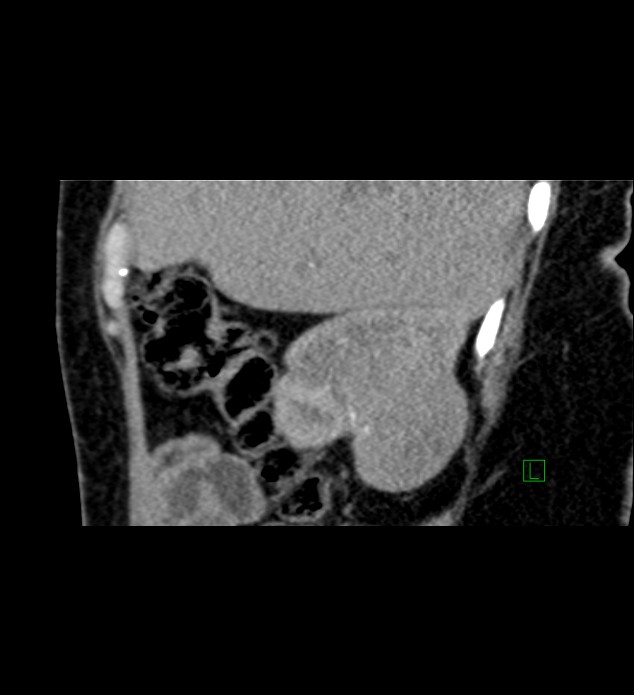 Chromophobe renal cell carcinoma (Radiopaedia 84290-99582 D 76).jpg