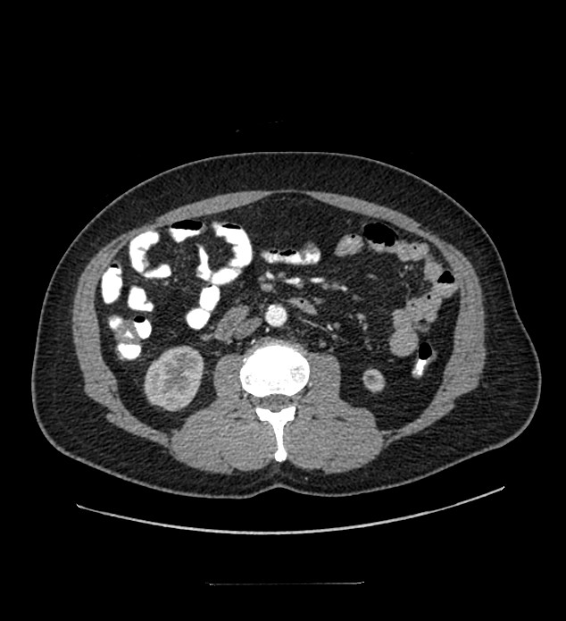 Chromophobe renal cell carcinoma (Radiopaedia 84337-99644 B 53).jpg