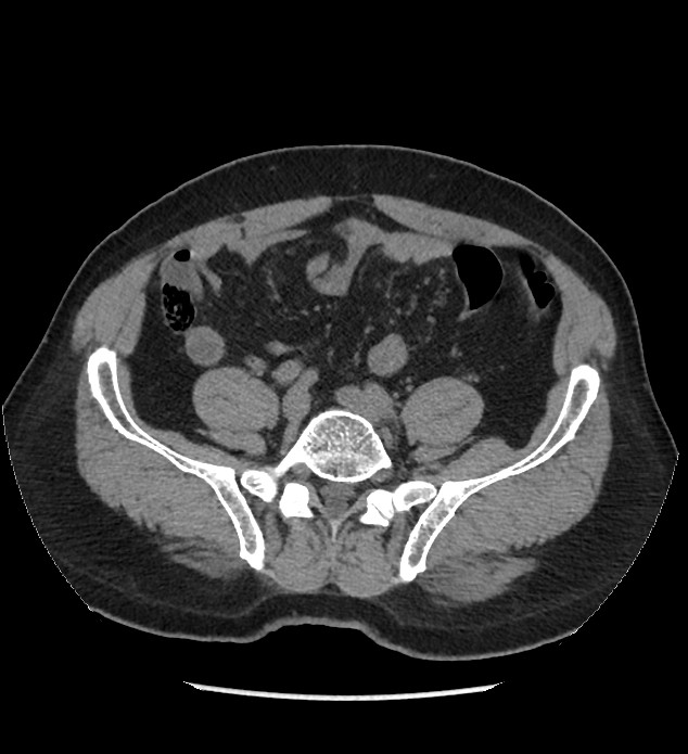 Chromophobe renal cell carcinoma (Radiopaedia 86879-103083 Axial non-contrast 86).jpg
