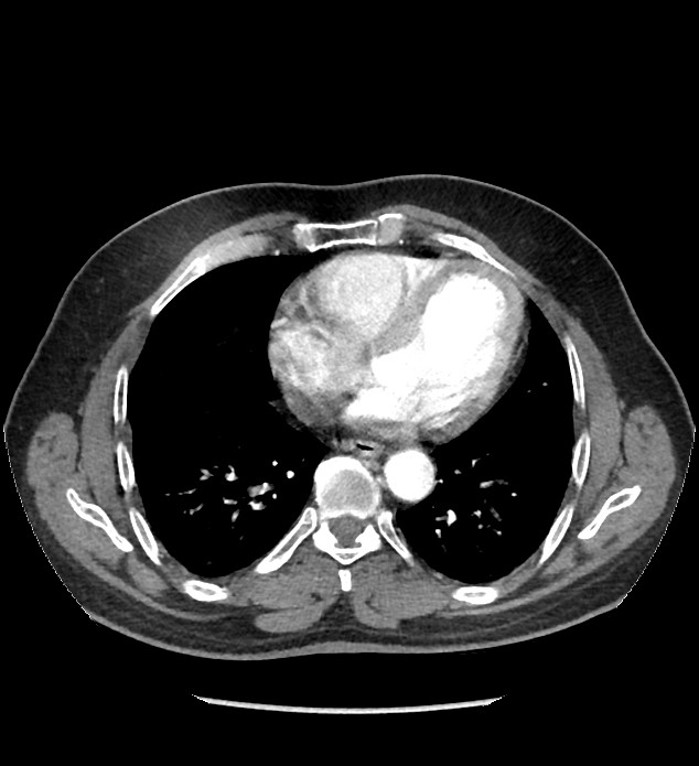 Chromophobe renal cell carcinoma (Radiopaedia 86879-103083 B 2).jpg