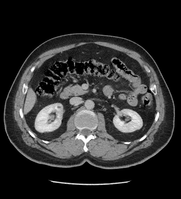 Chromophobe renal cell carcinoma (Radiopaedia 86879-103083 C 58).jpg