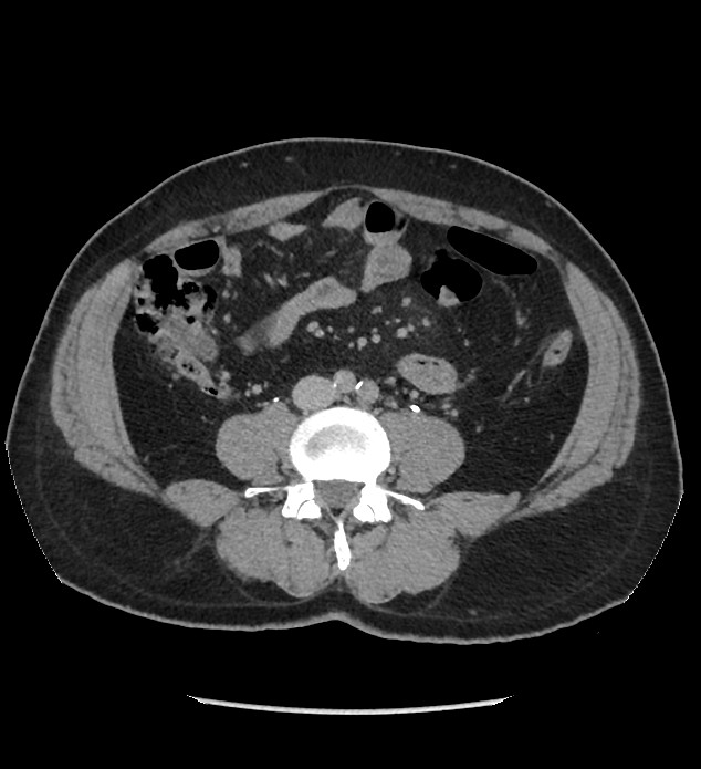 Chromophobe renal cell carcinoma (Radiopaedia 86879-103083 D 87).jpg