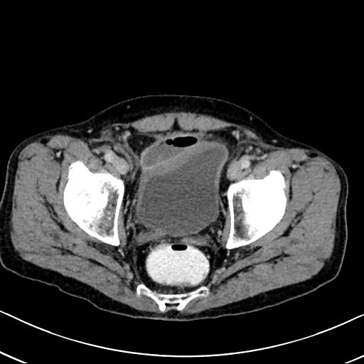 Chronic appendicitis complicated by appendicular abscess, pylephlebitis and liver abscess (Radiopaedia 54483-60700 B 132).jpg