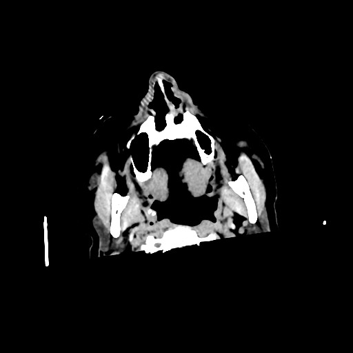 Chronic bilateral subdural hygroma (Radiopaedia 85801-101622 Axial non-contrast 11).jpg