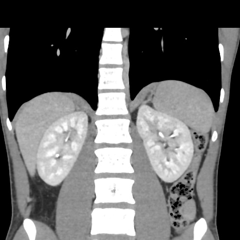 File:Chronic calcific pancreatitis (Radiopaedia 56280-62953 F 22).jpg