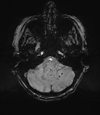 Chronic hypertensive encephalopathy (Radiopaedia 72844-83495 Axial SWI 16).png
