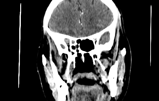 Chronic invasive fungal sinusitis (Radiopaedia 91563-109286 D 70).jpg