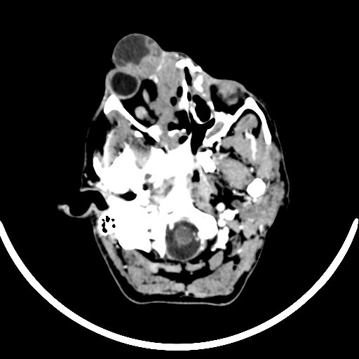 Chronic invasive fungal sinusitis with intraorbital and intracranial extension (Radiopaedia 56387-63046 B 71).jpg
