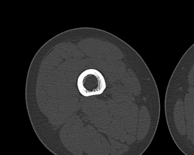 Chronic ostemyelitis of the femur with long sinus tract (Radiopaedia 74947-85982 Axial bone window 90).jpg