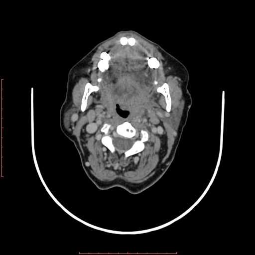 File:Chronic osteomyelitis - maxilla (Radiopaedia 23783-23927 B 37).jpg