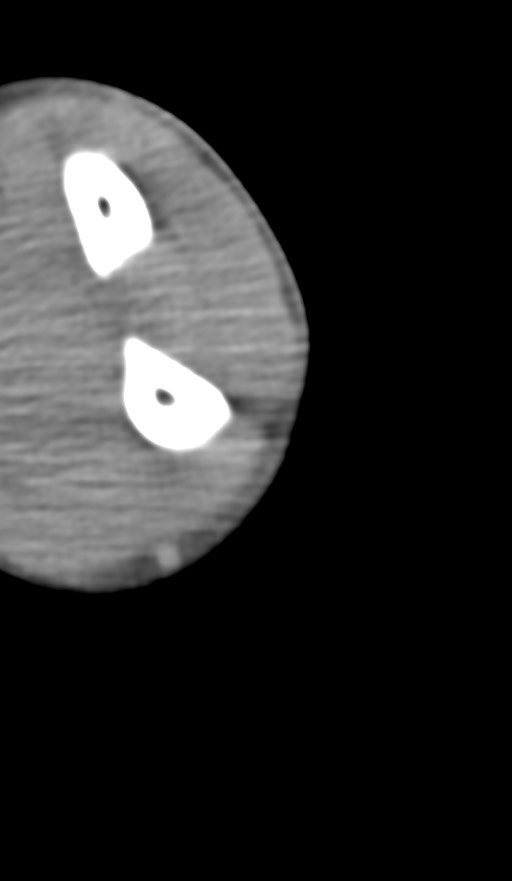 Chronic osteomyelitis of the distal humerus (Radiopaedia 78351-90971 Axial non-contrast 133).jpg