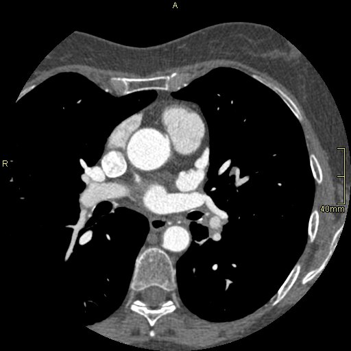 Chronic pulmonary embolism (Radiopaedia 73073-85094 Axial C+ CTPA 73).jpg