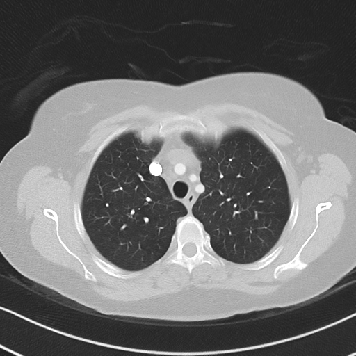 Chronic pulmonary embolus (Radiopaedia 39129-41341 Axial lung window 17).png