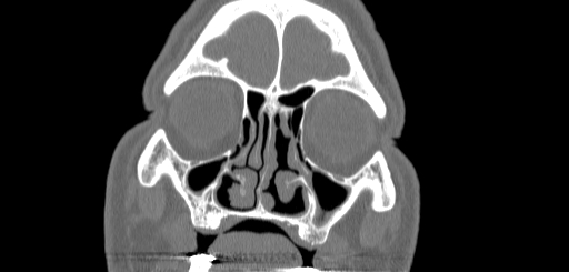 Chronic sphenoidal sinusitis (Radiopaedia 62030-70122 Coronal bone window 37).jpg
