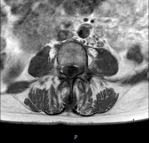 File:Chronic spinal hematoma with cauda equina syndrome (Radiopaedia 75745-87090 Axial T1 17).png