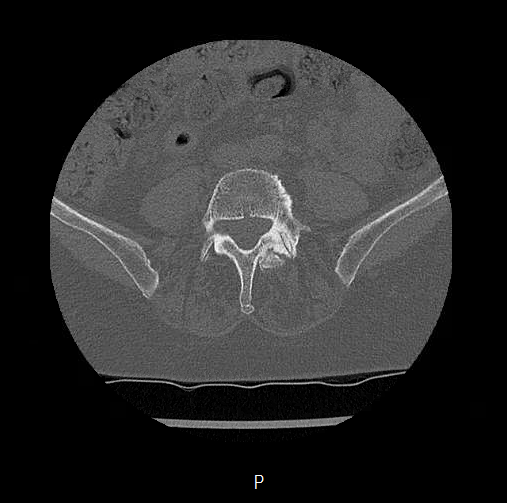 Chronic spinal hematoma with cauda equina syndrome (Radiopaedia 75745-88197 Axial bone window 60).png