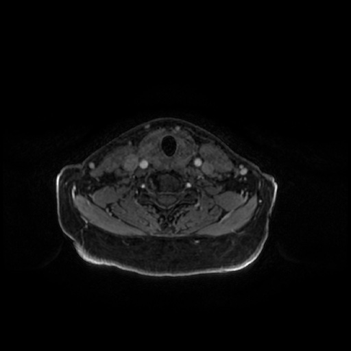 Chronic submandibular sialadenitis (Radiopaedia 61852-69885 Axial T1 C+ fat sat 14).jpg