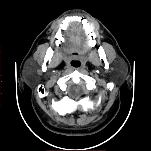 File:Chronic submandibular sialolithiasis (Radiopaedia 69817-79814 Axial non-contrast 56).jpg