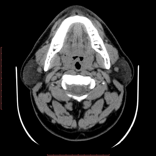 Chronic submandibular sialolithiasis (Radiopaedia 69817-79814 Axial non-contrast 79).jpg