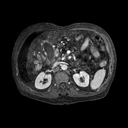File:Cirrhosis and hepatocellular carcinoma in the setting of hemochromatosis (Radiopaedia 75394-86594 Axial T1 C+ fat sat 202).jpg
