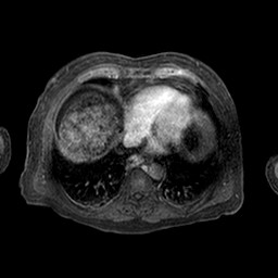 Cirrhosis and hepatocellular carcinoma in the setting of hemochromatosis (Radiopaedia 75394-86594 Axial T1 C+ fat sat 334).jpg