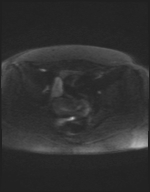 Class II Mullerian duct anomaly- unicornuate uterus with rudimentary horn and non-communicating cavity (Radiopaedia 39441-41755 Axial DWI 80).jpg
