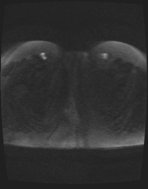 File:Class II Mullerian duct anomaly- unicornuate uterus with rudimentary horn and non-communicating cavity (Radiopaedia 39441-41755 Axial DWI 95).jpg
