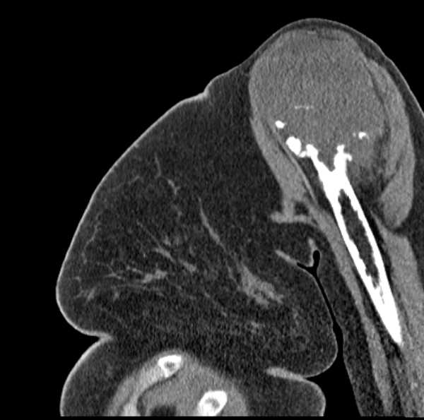 File:Clear cell chondrosarcoma - humerus (Radiopaedia 63104-71612 D 19).jpg
