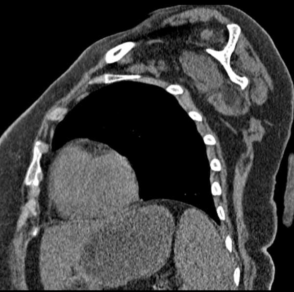 Clear cell chondrosarcoma - humerus (Radiopaedia 63104-71612 D 44).jpg