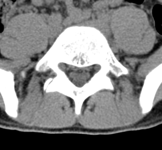 Clear cell meningoma - lumbar spine (Radiopaedia 60116-67691 Axial non-contrast 61).png