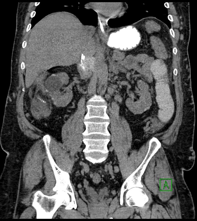 Closed-loop small bowel obstruction-internal hernia (Radiopaedia 78439-91096 Coronal non-contrast 61).jpg